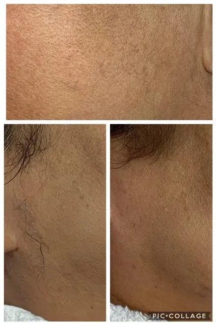 dermaplaning aw medspa