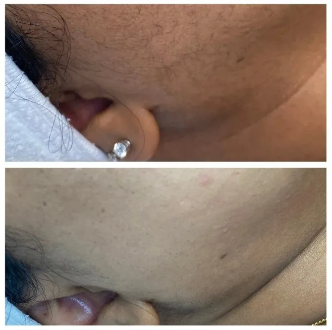 dermaplaning aw medspa