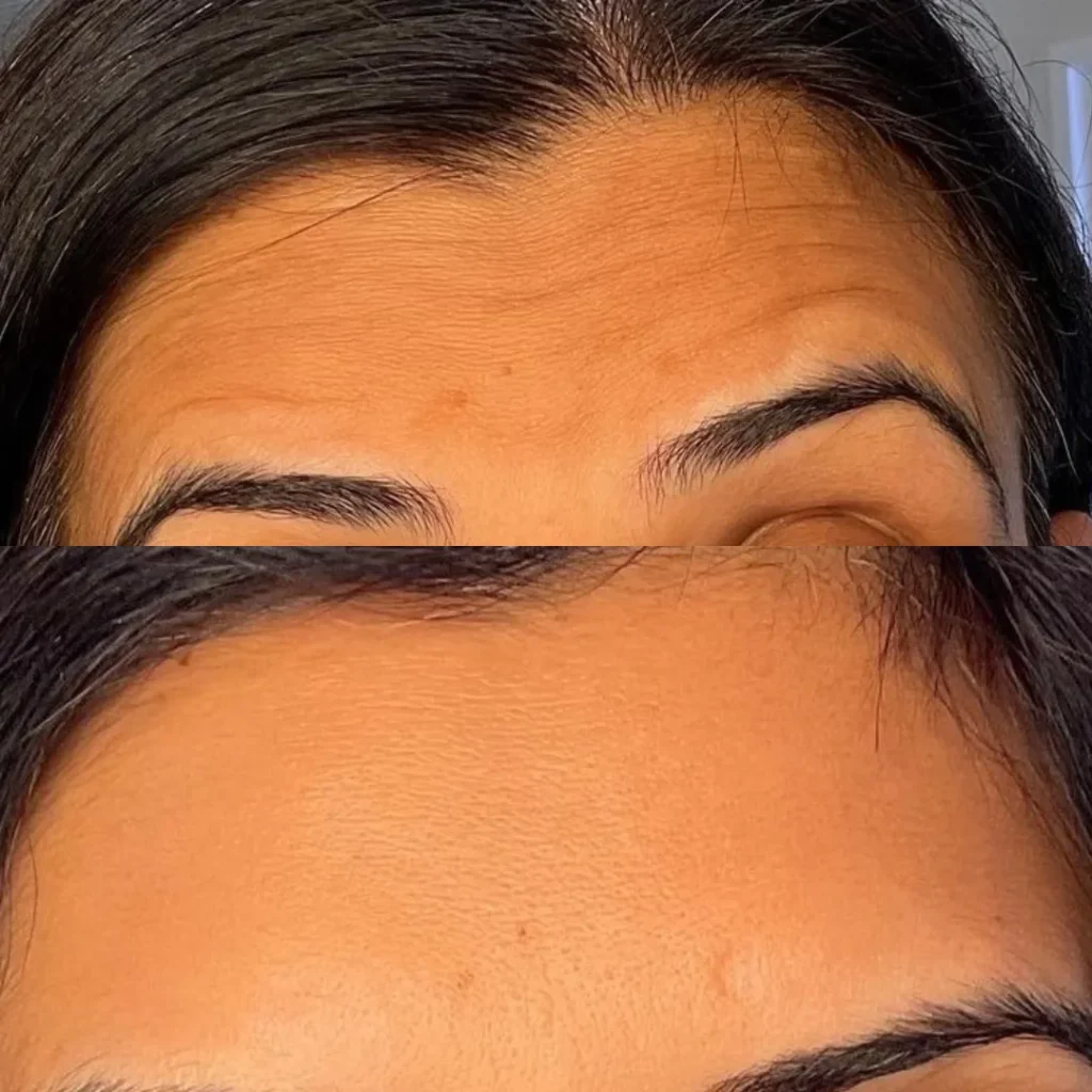Botox+1+Website-1280w