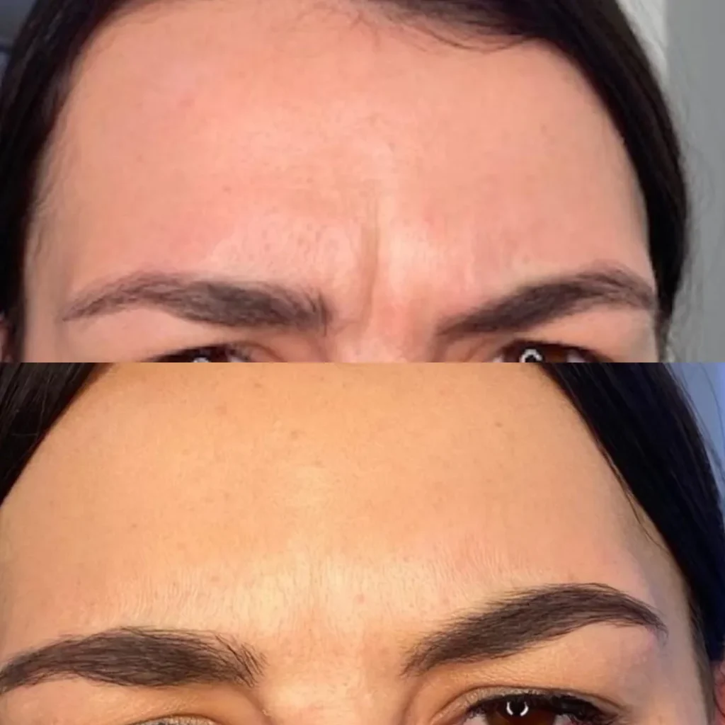 Botox+2+Website-1280w