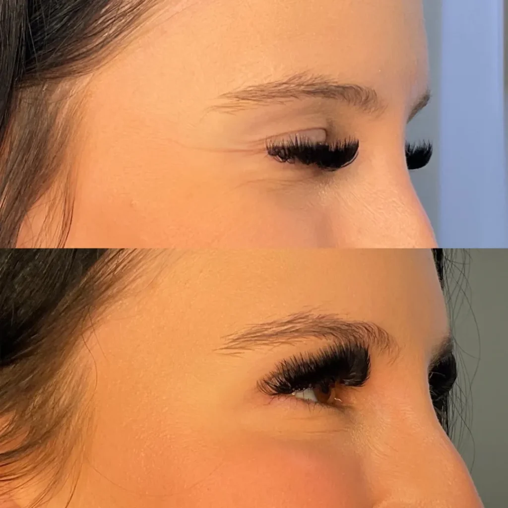 Botox+B-A-1280w