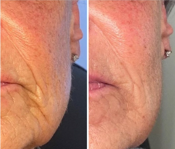 Cheek-Filler-B-A-2