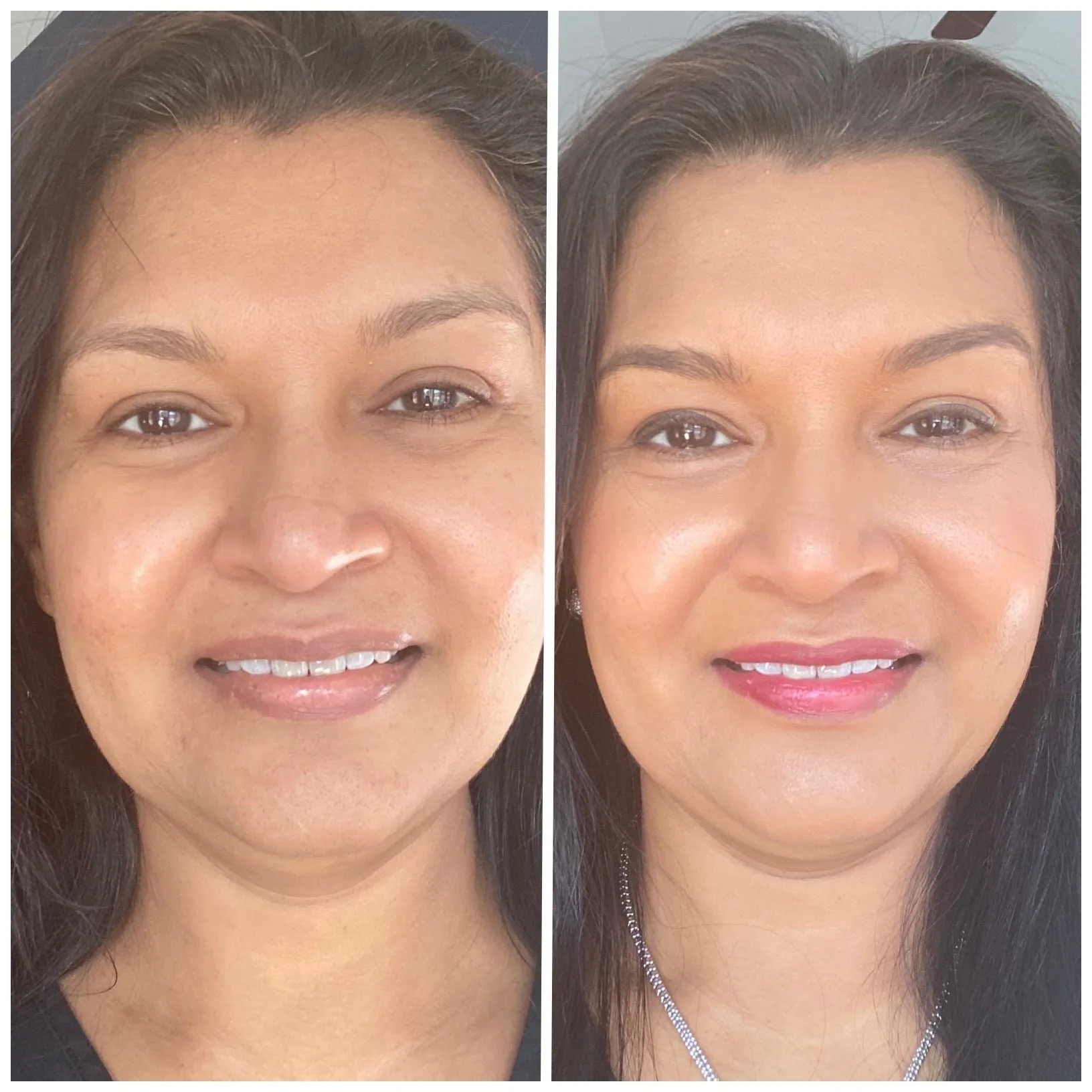 chemical peels aw medspa