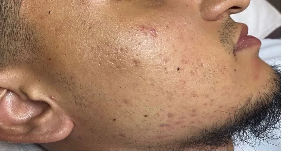 microneedling aw medspa