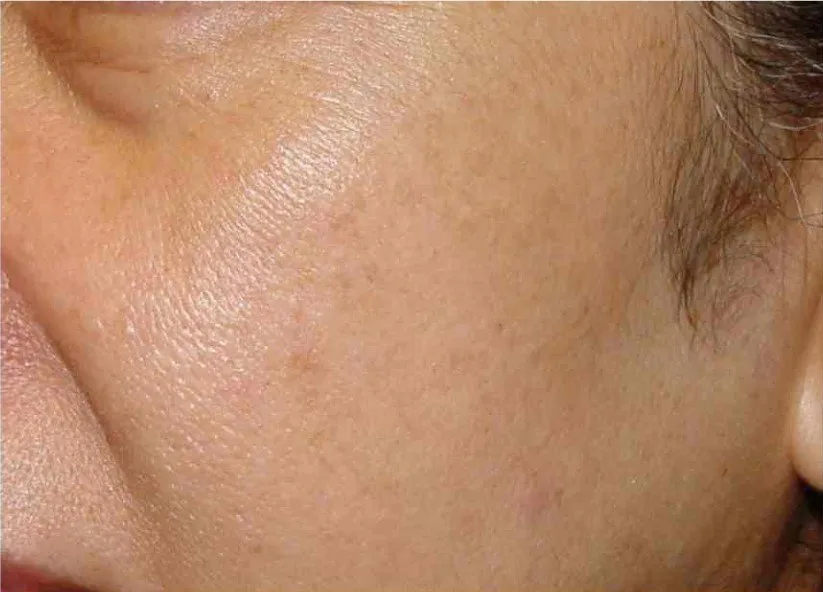 Laser Skin Rejuvenation Services: PhotoFacial IPL & Laser Genesis aw medspa