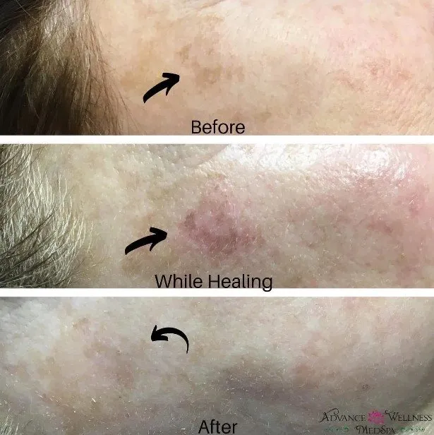 Laser Skin Rejuvenation Services: PhotoFacial IPL & Laser Genesis aw medspa