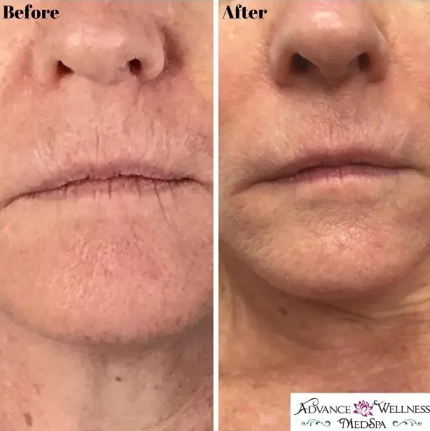 Laser Skin Rejuvenation Services: PhotoFacial IPL & Laser Genesis aw medspa