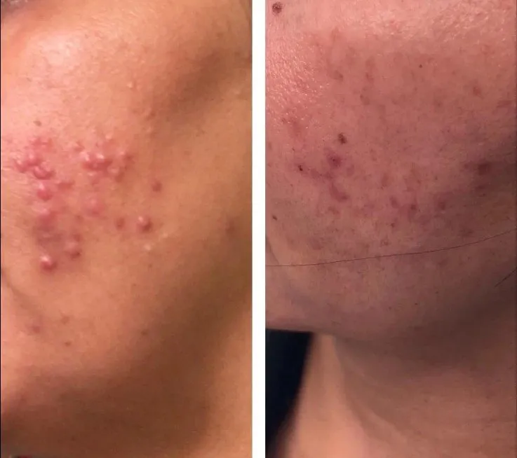 Laser Skin Rejuvenation Services: PhotoFacial IPL & Laser Genesis aw medspa