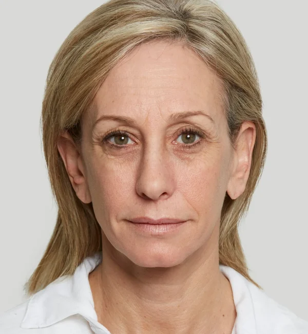 Heidi+before+front2-1920w Sculptra injectables aw medspa